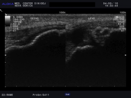 Ultrazvok kolena - kalcinacije v patelarnem ligamentu, indikacija za ESWT 2